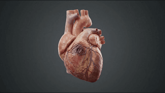 Detailed view of model of diseased human heart