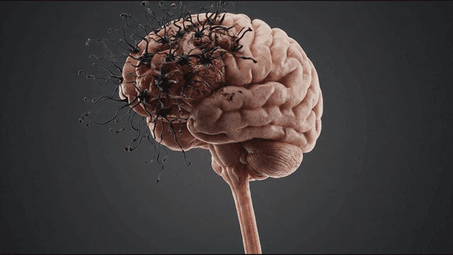 A brain with spreading infection