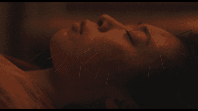 얼굴에 침 치료를 받는 여성