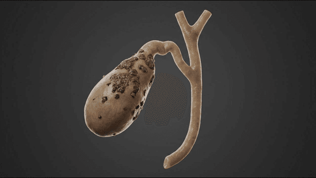 Gallbladder rotting away due to virus