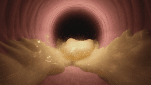 Inside a human artery with plaque buildup