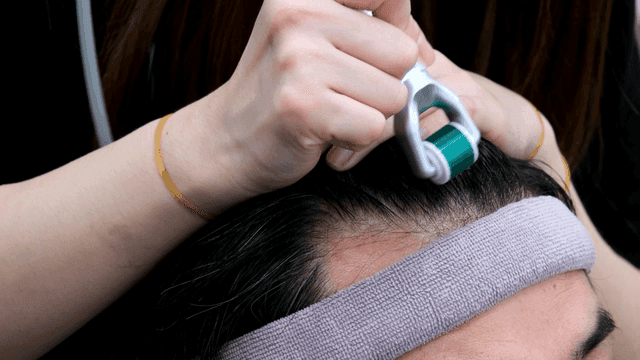Scalp treatment with a roller device