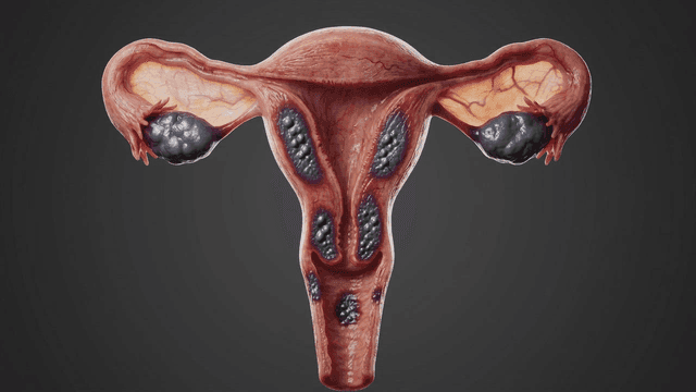 Detailed view of diseased female reproductive organs