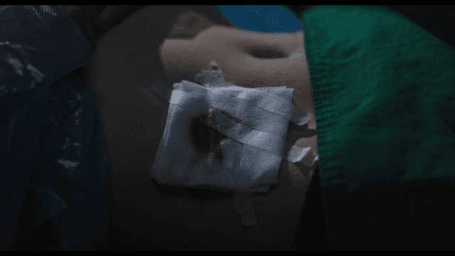 Gauze attached to patient’s abdomen