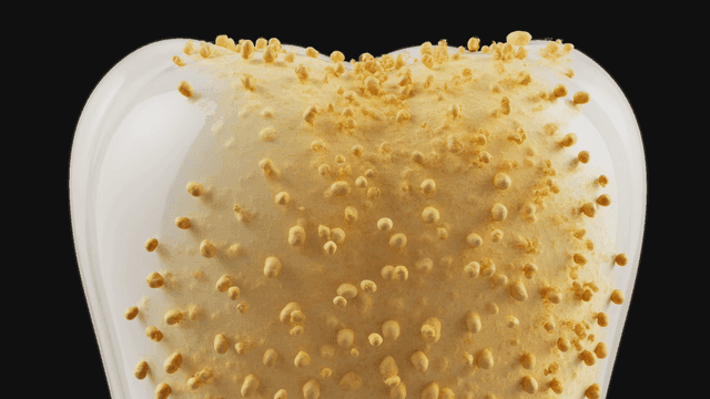 Close-up of tooth covered in yellow tartar