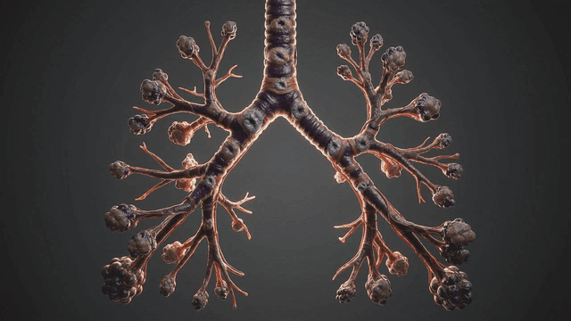 Detailed view of diseased human bronchial tubes