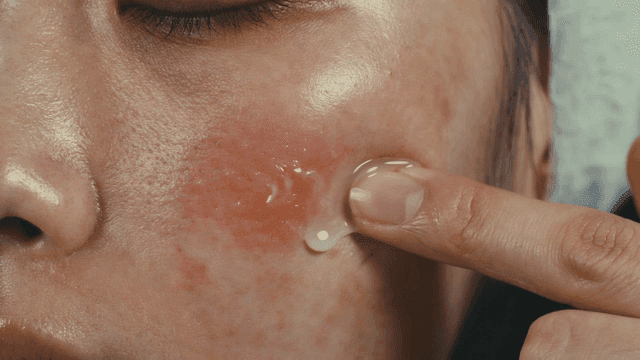 Hands applying cream to irritated skin