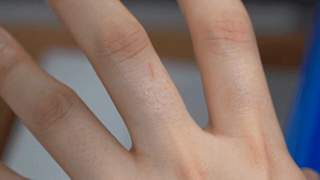 손가락에 난 상처