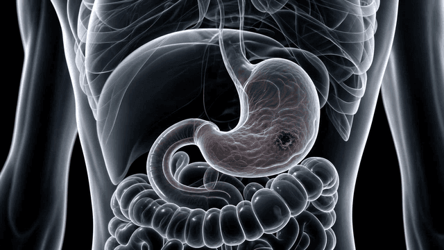 Detailed view of a stomach ulcer