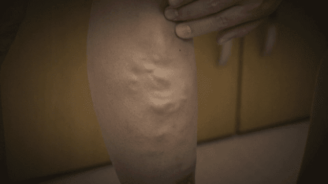 Legs with varicose veins