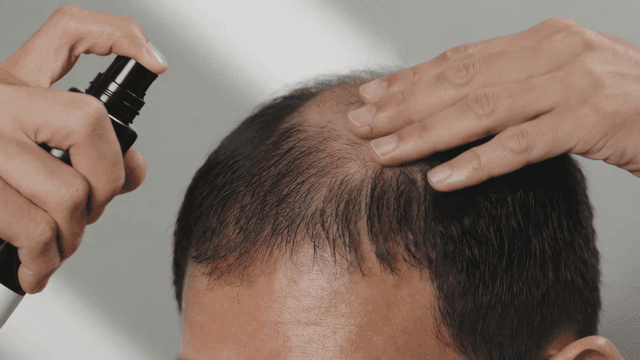 Applying hair spray on a balding scalp