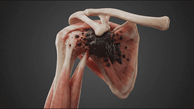 Detailed view of anatomy of decaying shoulder